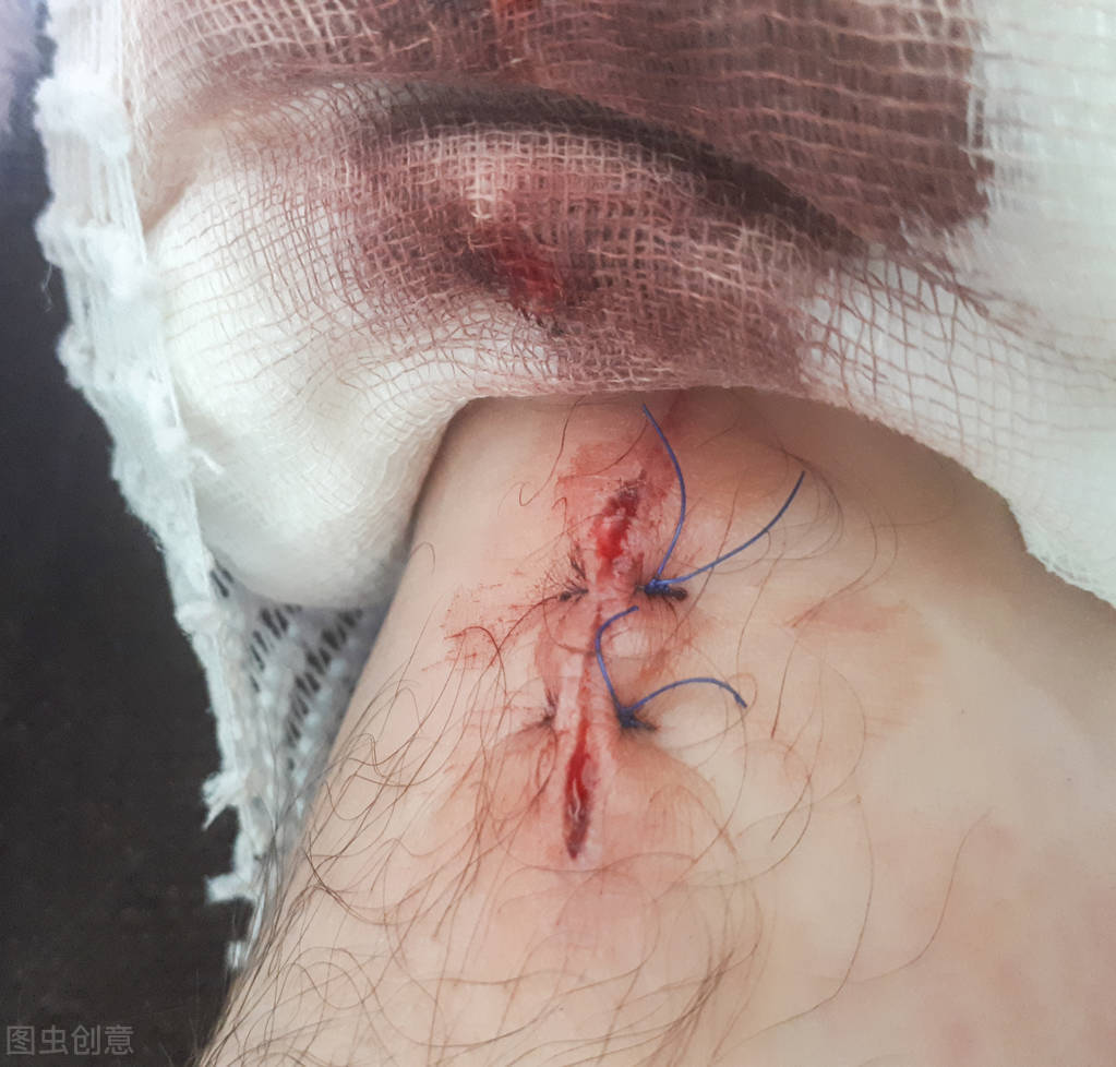 祛疤膏需要多长时间才能祛除疤痕,祛疤最佳治疗期