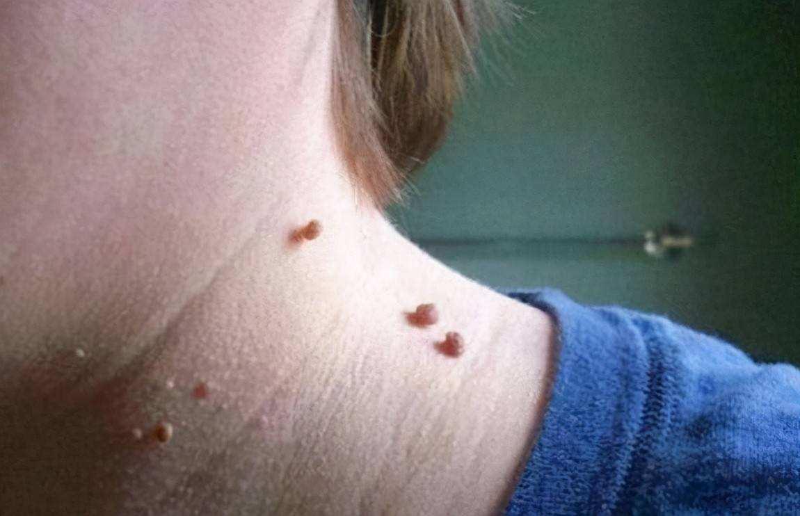 皮肤长“小肉球”是怎么回事，可以抠掉吗？该如何去除？望知晓