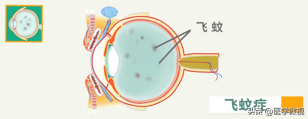 总感觉眼前有虫子在飞什么原因,老是觉得眼前有小飞虫在飞