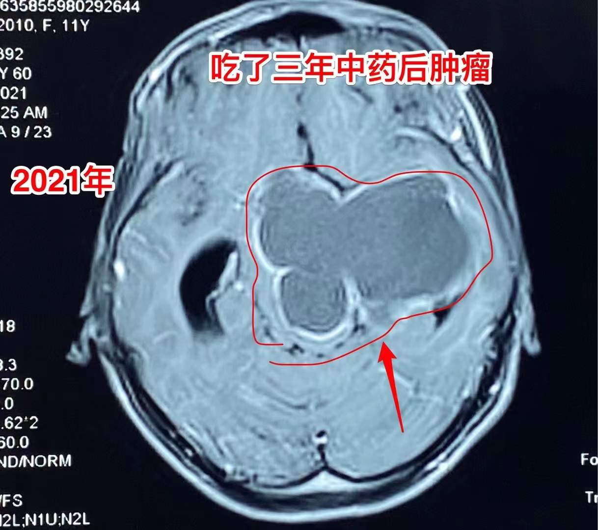 误区！吃中药能控制颅咽管瘤！颅咽管瘤最有效的治疗是手术