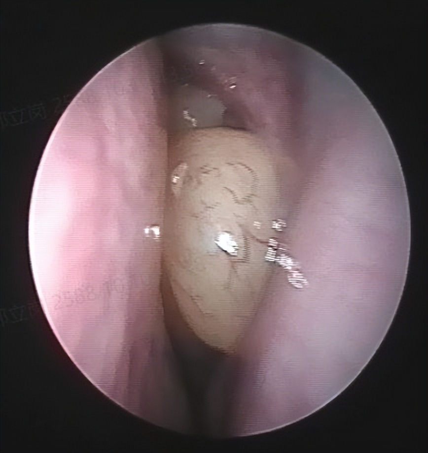反复鼻塞,好不了,这次总算找到了原因