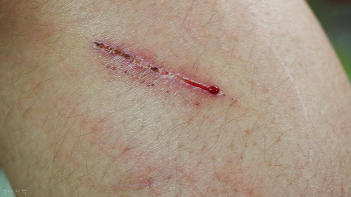 什么东西能够让血痂更快的恢复,血痂不小心弄掉了才能不留疤