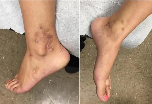 青斑血管病可以治愈吗,青斑是皮肤病还是血管病