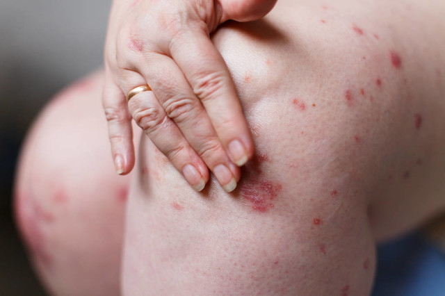 焗油过敏引起过敏性皮炎怎么办,过敏性皮炎螨虫过敏怎么治合适