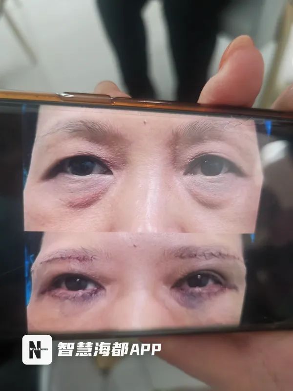 福州医美中介水太深，“闺蜜”介绍手术，发票价与实际花费差十倍