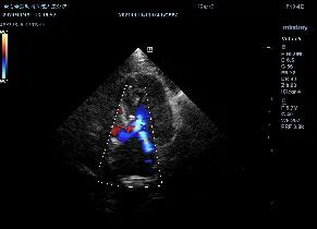 二尖瓣发育不良病例总结