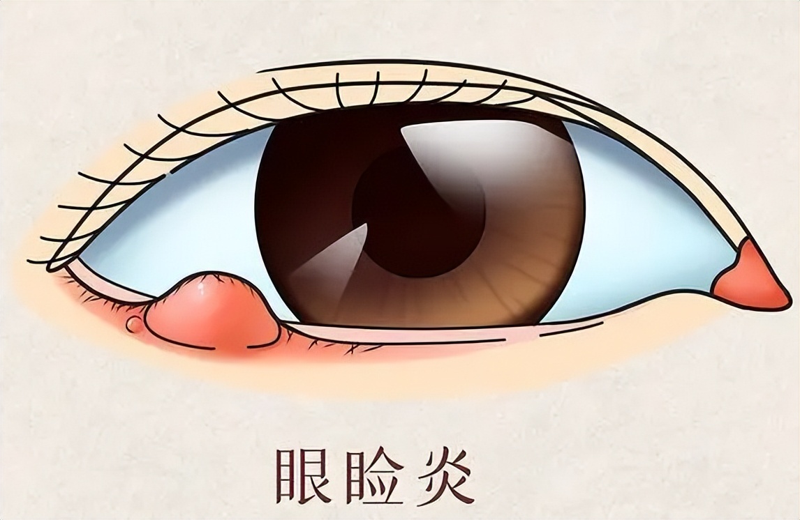 眼角银屑病的症状,眼皮银屑病的症状