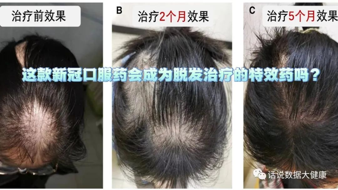 首个获批治疗严重脱发的药物，服用后就像脱发从未发生一样？