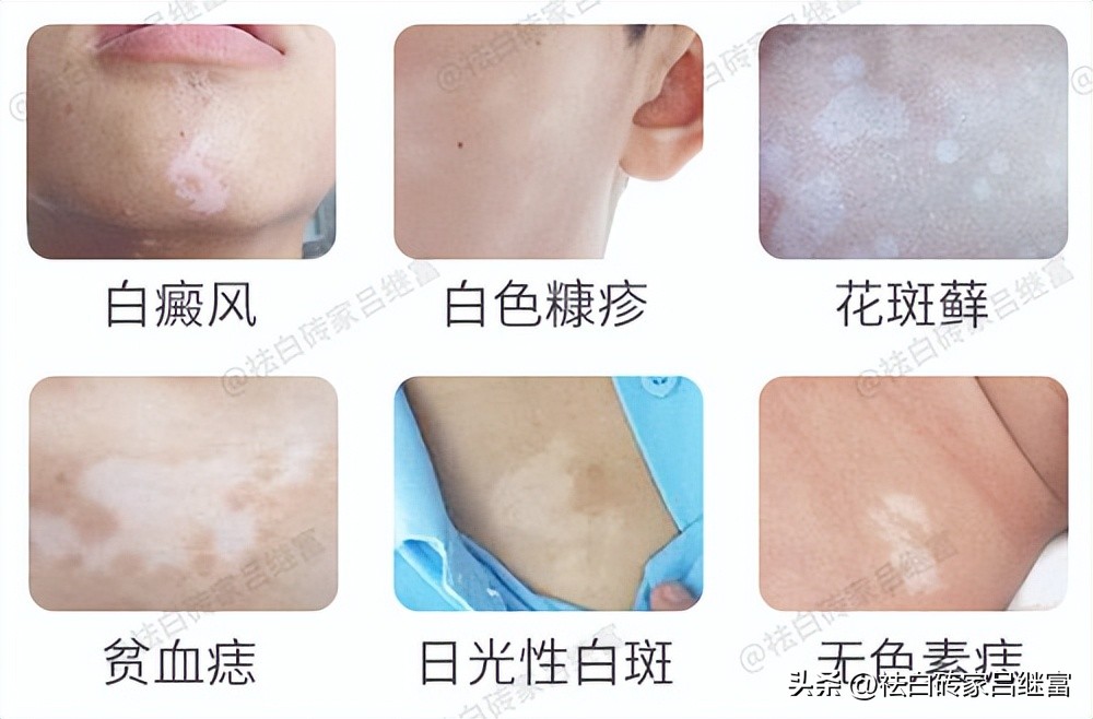 初期白斑多长时间就严重了,初期白斑病较好的治疗方法