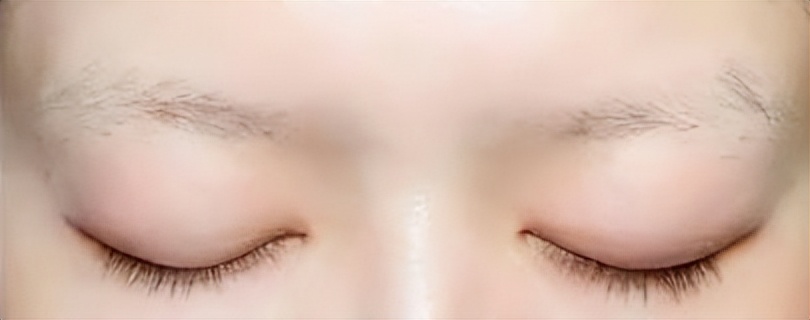 脱发后毛发还能移植吗,毛发移植会脱发吗