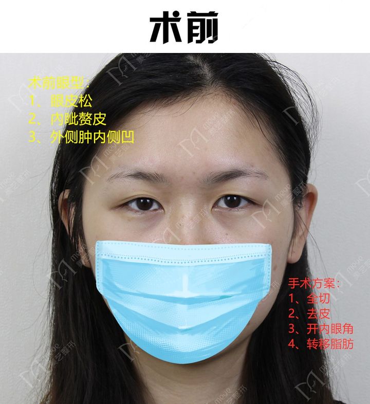 双眼皮术后大小眼是什么原因,双眼皮术后大小眼30天恢复图