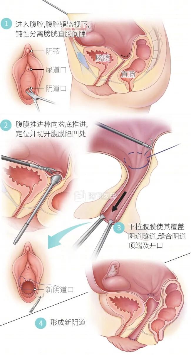 十七岁女孩被确诊,17岁女孩被诊断为石女