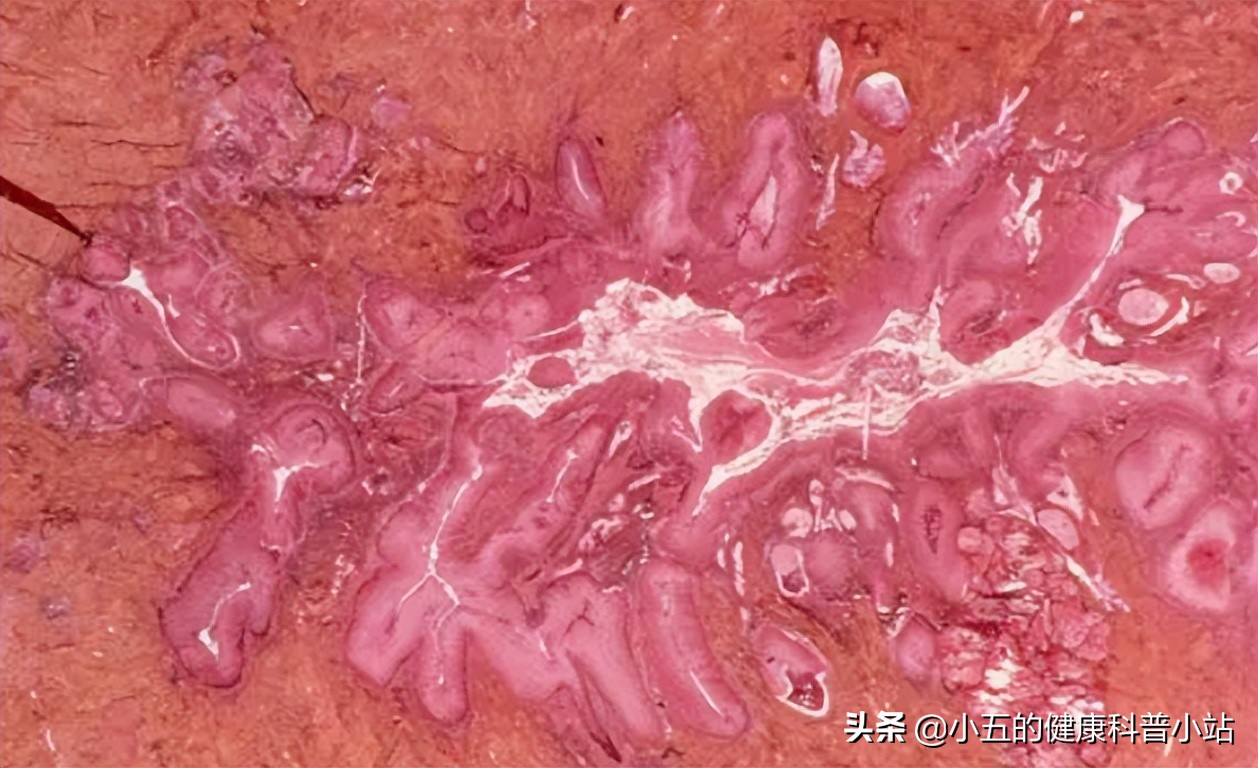 宫颈癌早期有哪些常见的症状表现,宫颈癌早期症状的三个表现