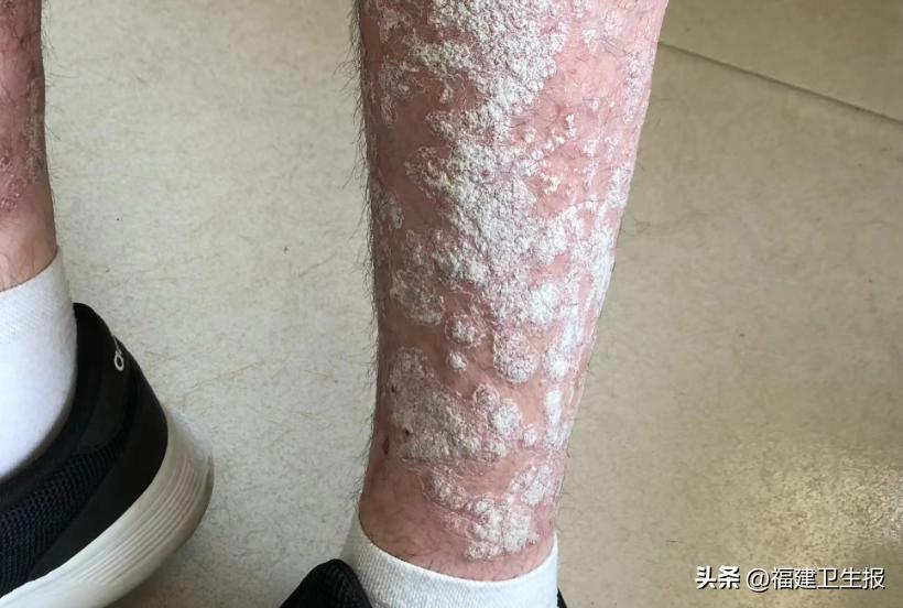阳了后浑身痒、起疹子？医生提醒：分清类型再治疗