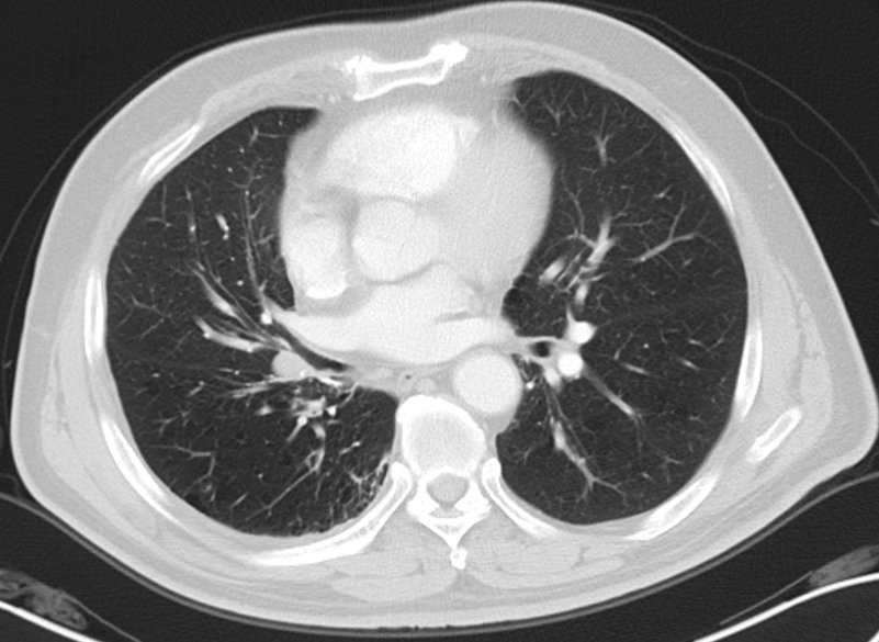 肺癌术后复发胸膜转移,肺癌术后复发转移还需要治疗吗
