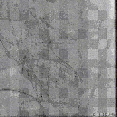 病例回顾与分享,腹膜后血肿介入治疗
