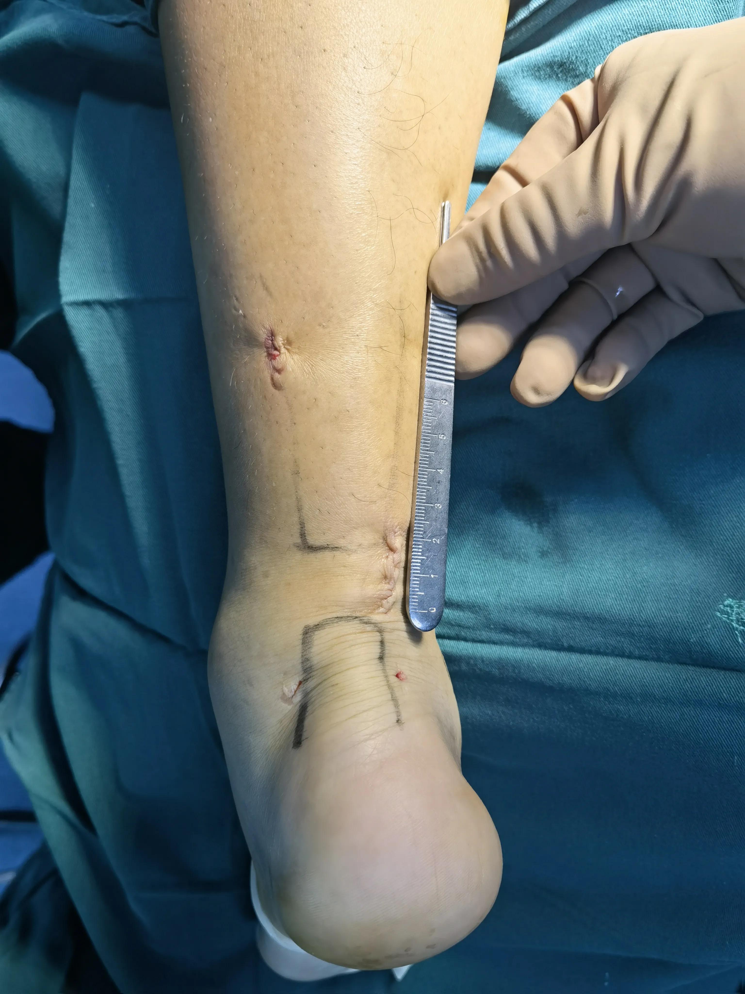 跟腱断裂的微创治疗,跟腱断裂微创手术修复演示图