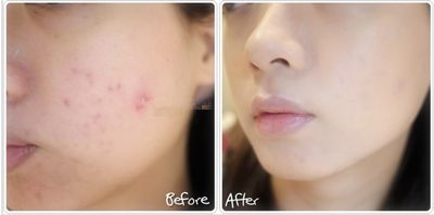 如何让脸上的痘痘一夜之间就能消,怎样可以把脸上的痘痘给消除