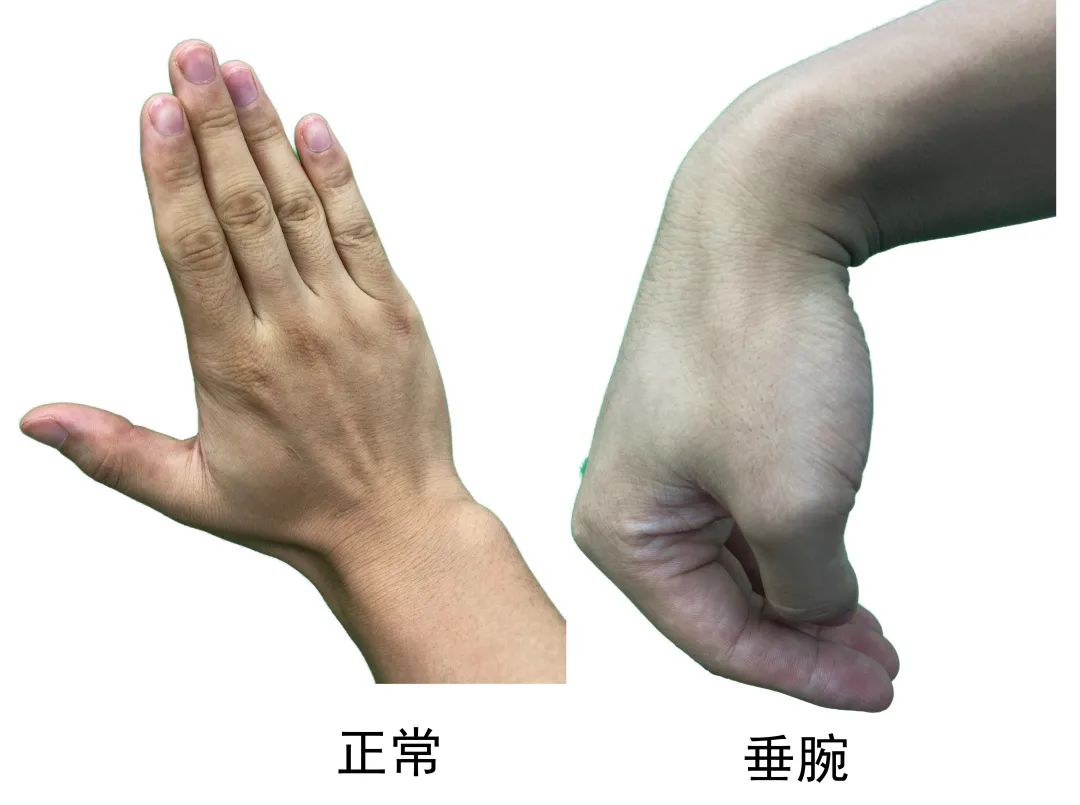 手腕抬不起来什么原因如何治,肱骨骨折手腕抬不起来怎么治