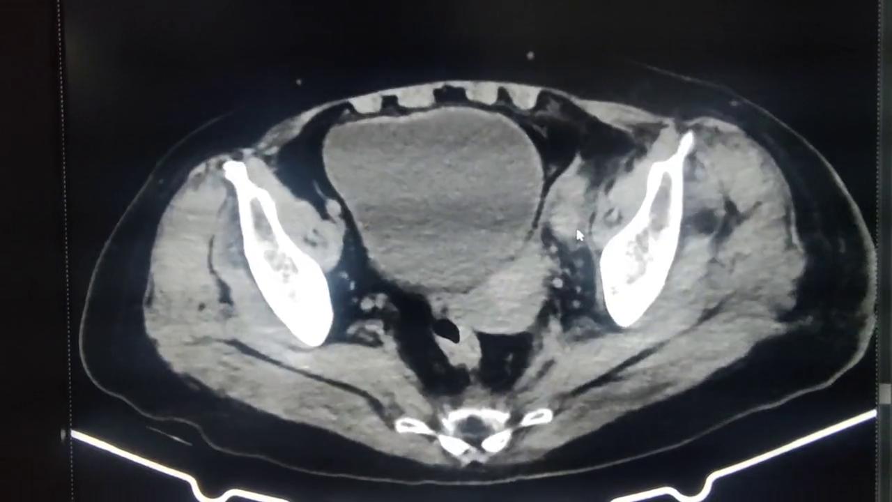 下肢深静脉血栓介入治疗视频,下肢腘静脉血栓保守治疗能治愈吗