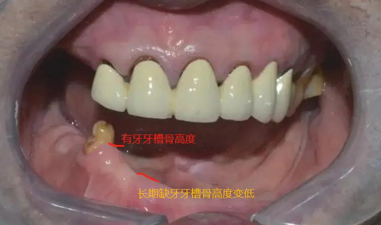 缺牙后，如何防止牙槽骨吸收？专家给出3个有效办法