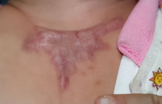 色素疤痕和烫伤疤痕,烧烫伤疤痕好治还是刀伤疤痕好治