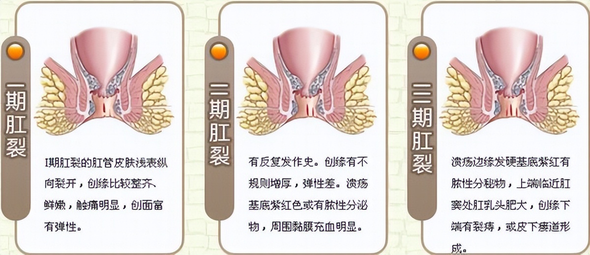 引起肛裂最常见的原因,女性易患肛裂的原因是什么