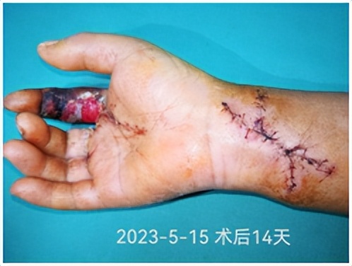 手指被牙签扎了没流血有脓液,手指被扎了一下没有破但是有红点