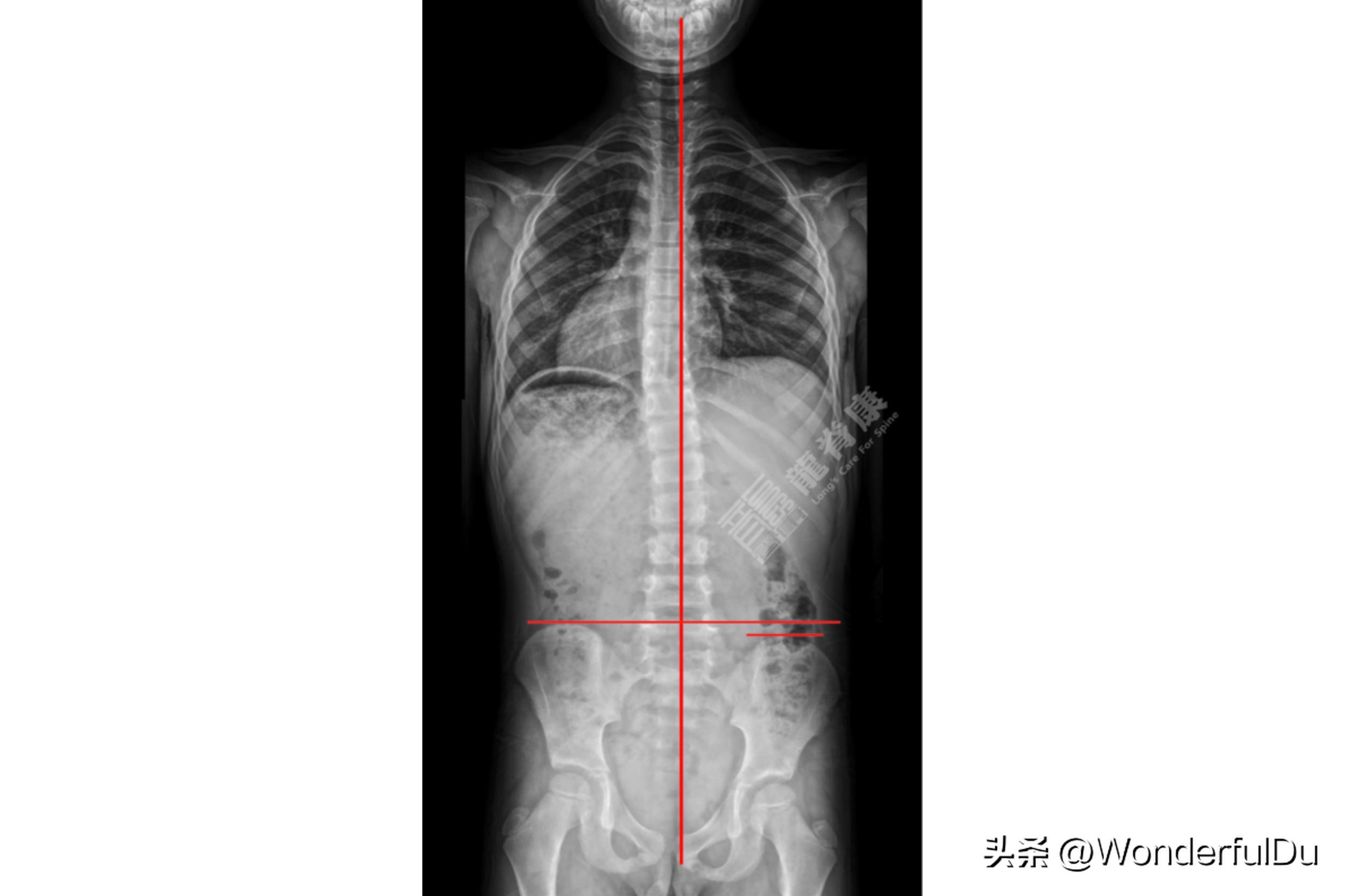 儿童脊柱侧弯导致长短脚怎样矫正,脊柱侧弯引起的长短脚能治愈吗