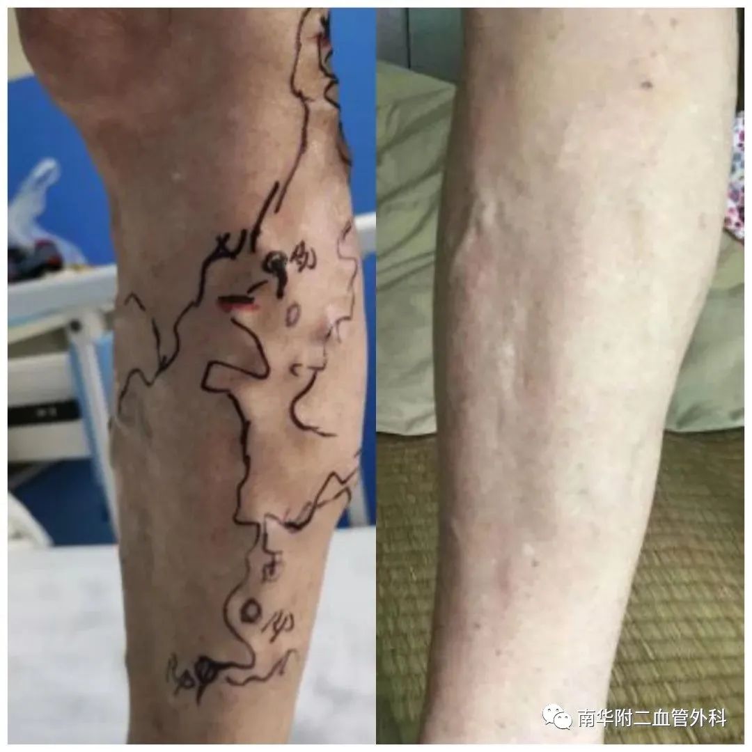 chiva治疗精索静脉曲张,chiva治疗静脉曲张武汉有吗