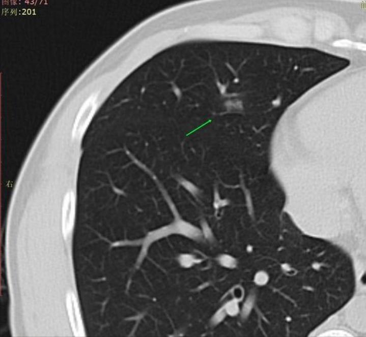 *疆新**28岁结友遇8mm混磨要手术治疗？精准诊断判定是炎症一定可消