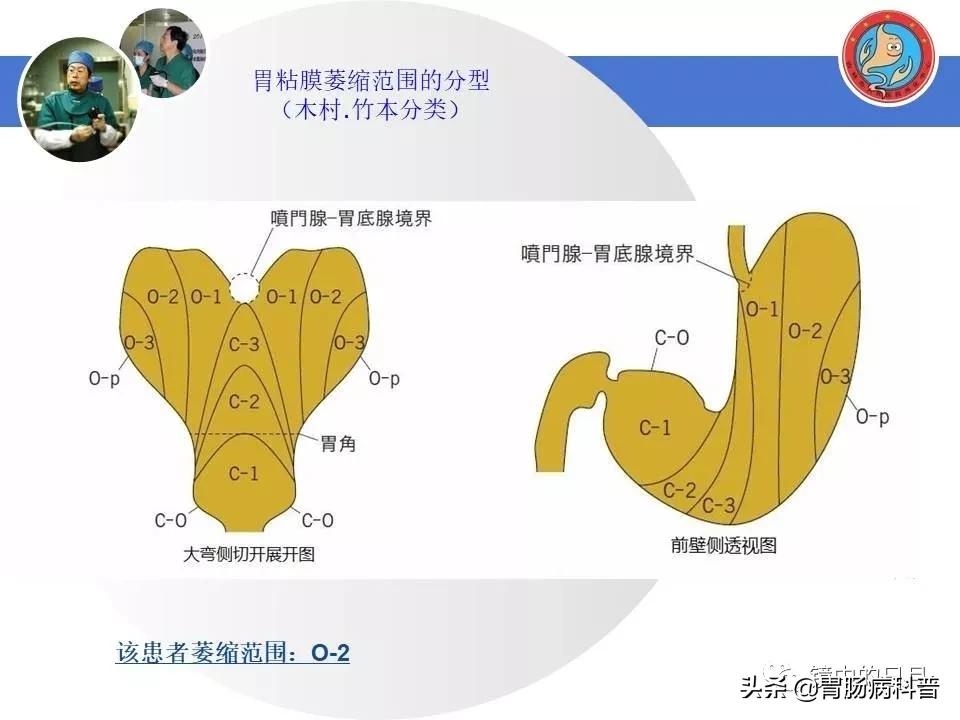 胃癌可以做内镜手术吗,早期胃癌内镜手术后追加外科手术