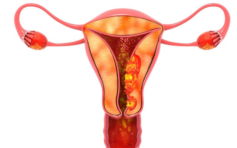 小心无故腿疼可能是宫颈癌,宫颈癌术后腿疼是怎么回事