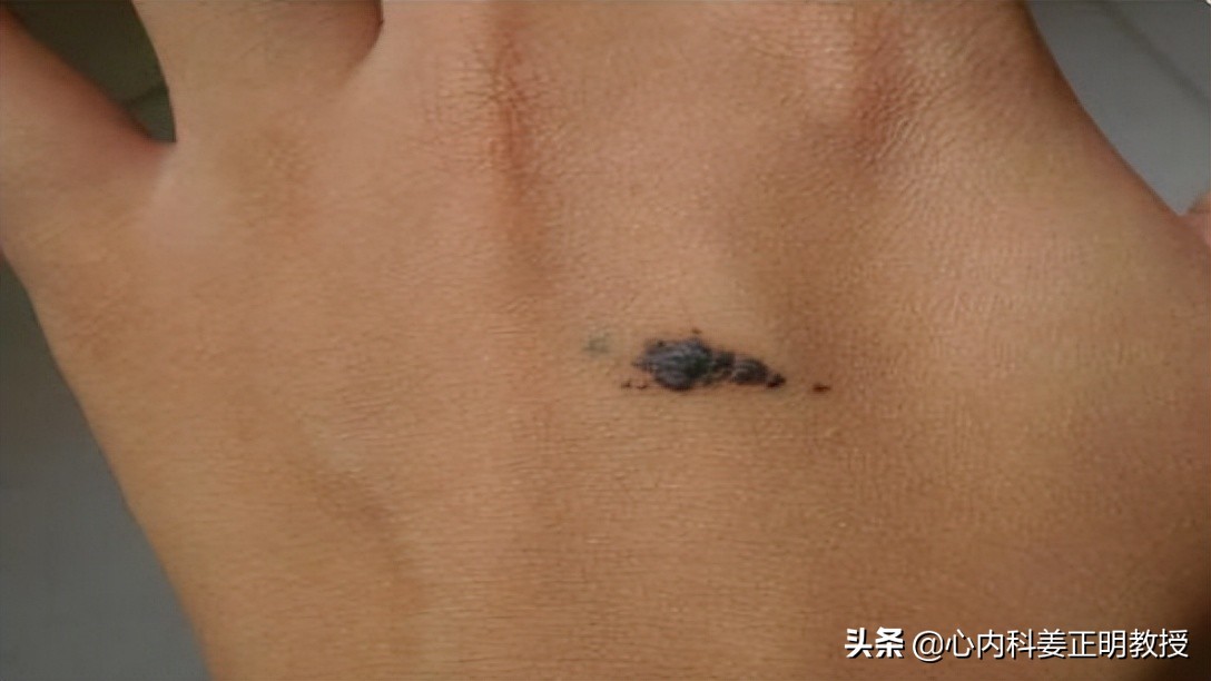 老年斑是只有老年人才会有的吗,老年人长老年斑对身体有影响吗