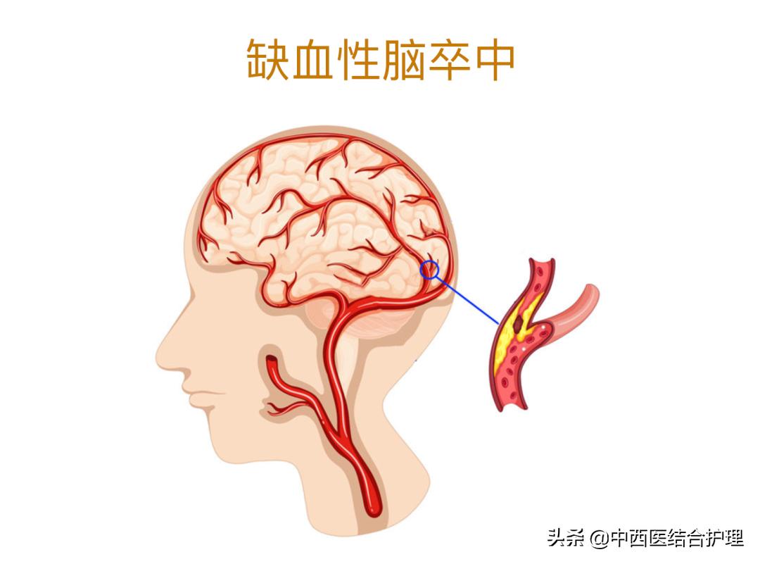 「脑梗病科普」一个周末8个脑梗，他们都有一共同特点！​神药安宫牛黄丸到底能不能救命？
