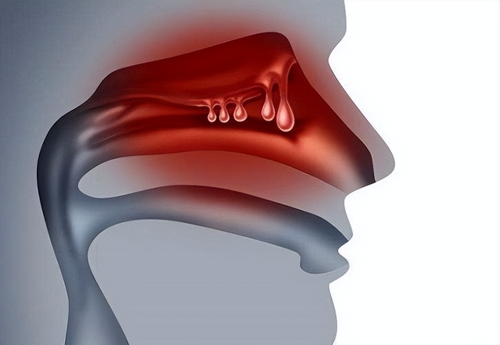 科普知识：鼻子里长了鼻息肉该怎么办？
