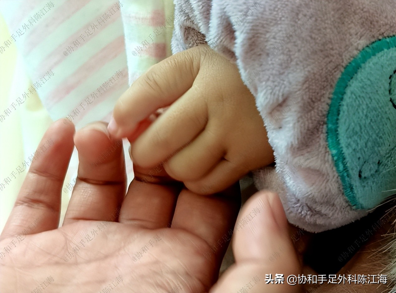 宝宝拇指畸形能矫正吗,孩子拇指畸形是什么原因