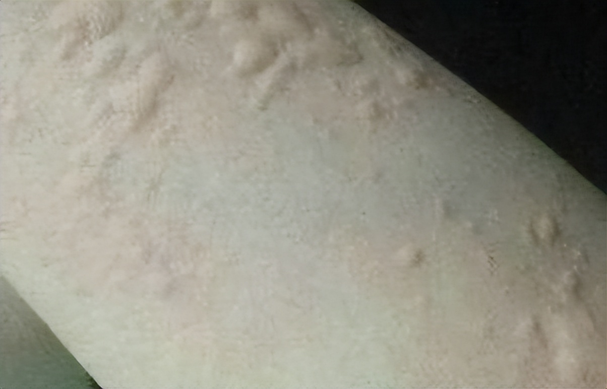 「*麻疹荨**」20%的人都会得的皮肤病，是什么原因？又该如何治疗？