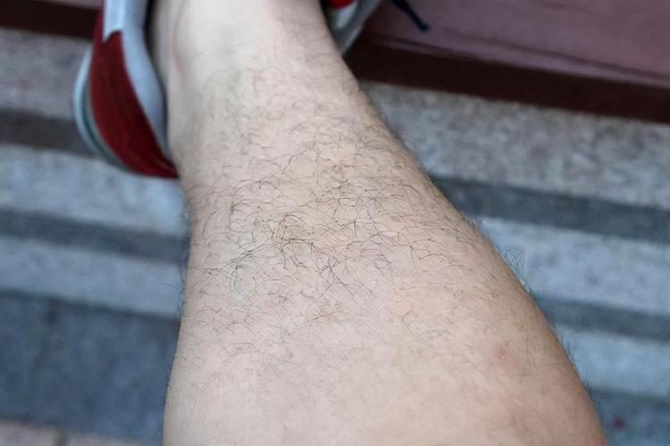 为什么有的女性体毛旺盛,有的却“光秃秃”呢?医生讲出大实话