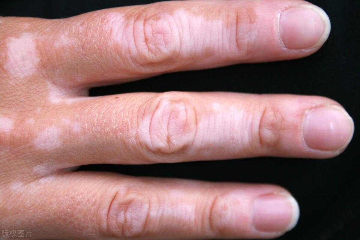 白癜风患者不要怕，了解以下4点问题，你的白癜风就离好不远了