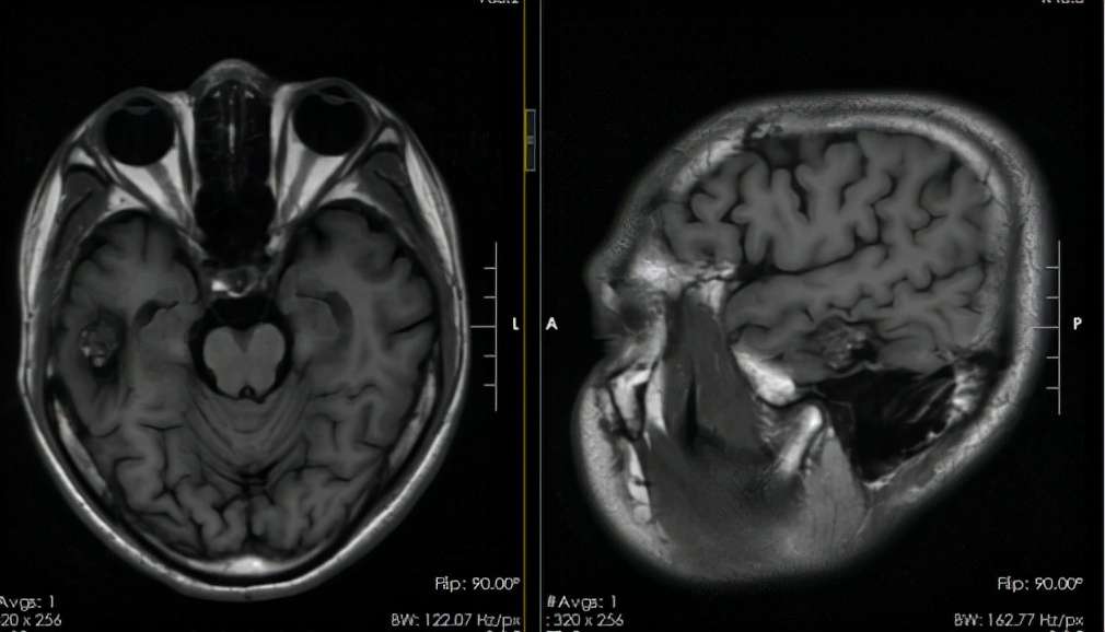 3岁男孩颅内肿瘤,33岁小伙肿瘤