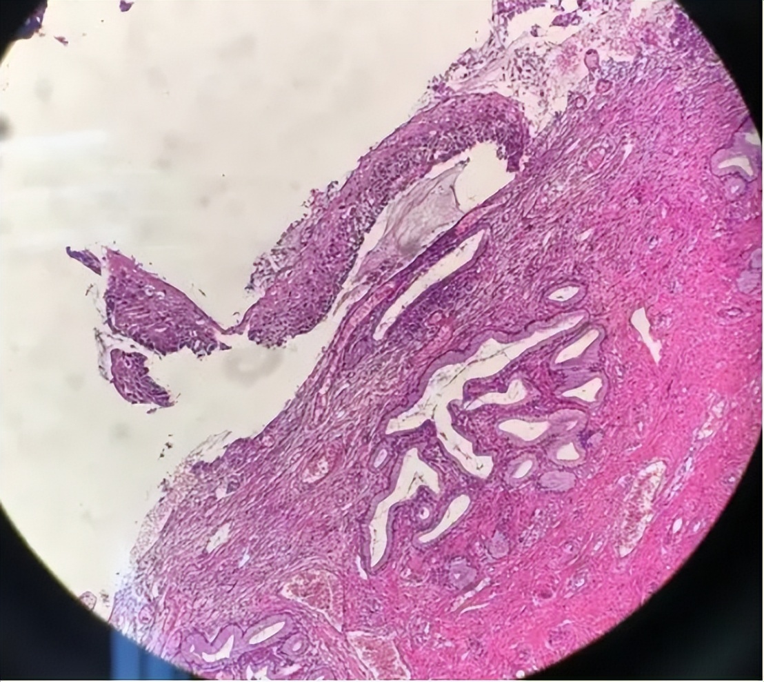 胃癌中晚期恶性肿瘤怎么治疗好,恶性程度低的胃癌