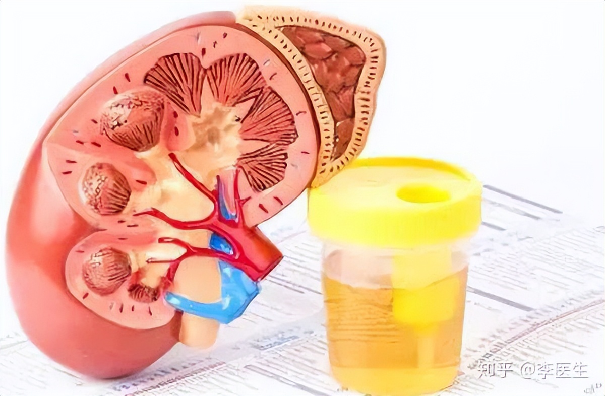 肾炎引起的浑身乏力怎么解决,慢性肾炎及时治疗会肾衰竭吗