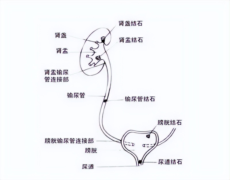 上尿路上皮癌根治性切除术,输尿管高级别浸润性尿路上皮癌
