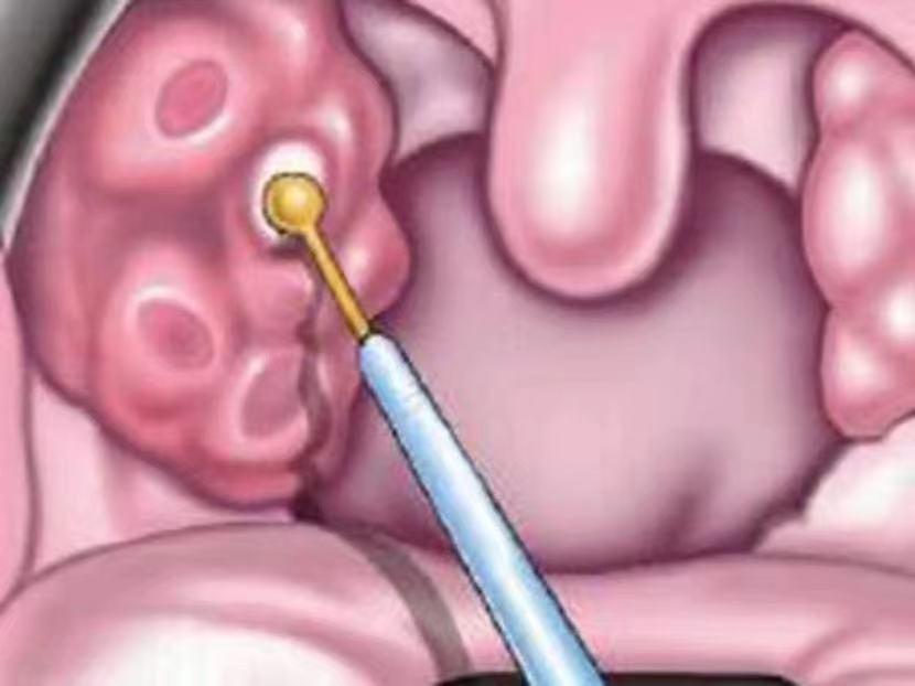 中医治慢性扁桃体炎的最佳方法,南宁中医烙法治疗慢性扁桃体炎