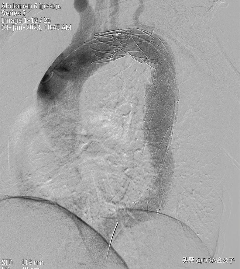 主动脉夹层动脉瘤的超声表现,主动脉夹层动脉瘤会左脚痛吗
