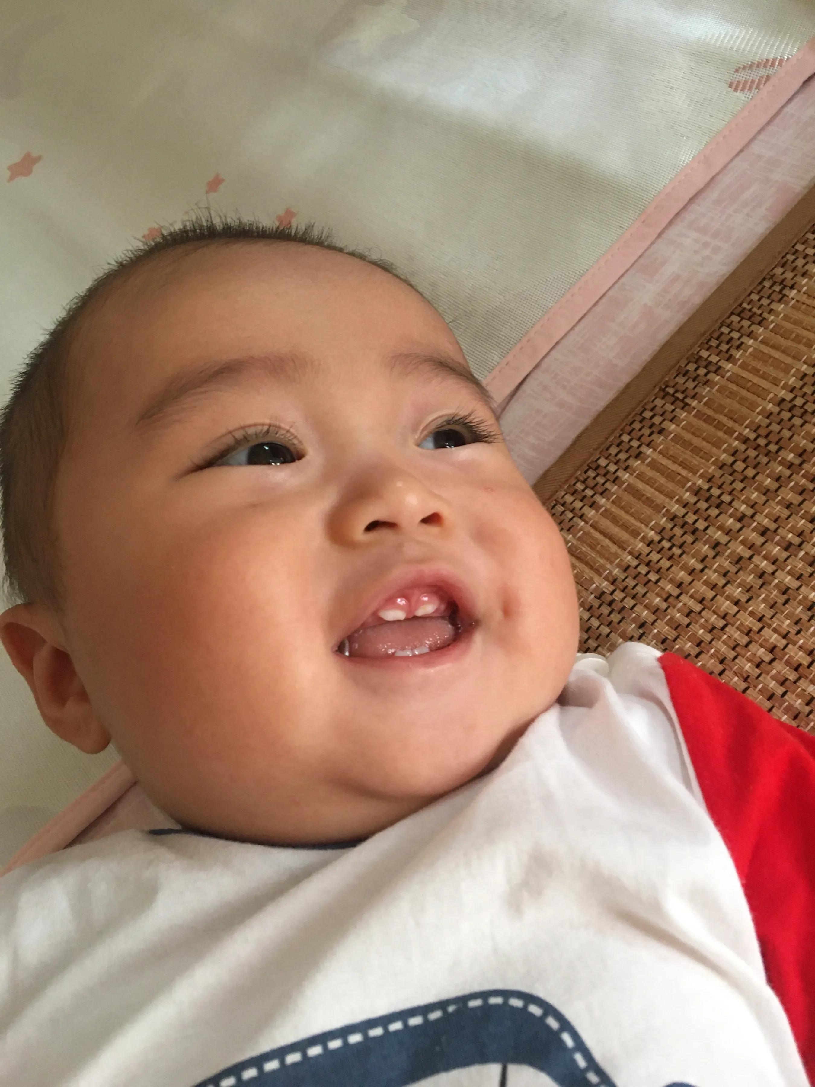 宝宝湿疹大作战,宝宝湿疹反复妈妈需要忌口什么