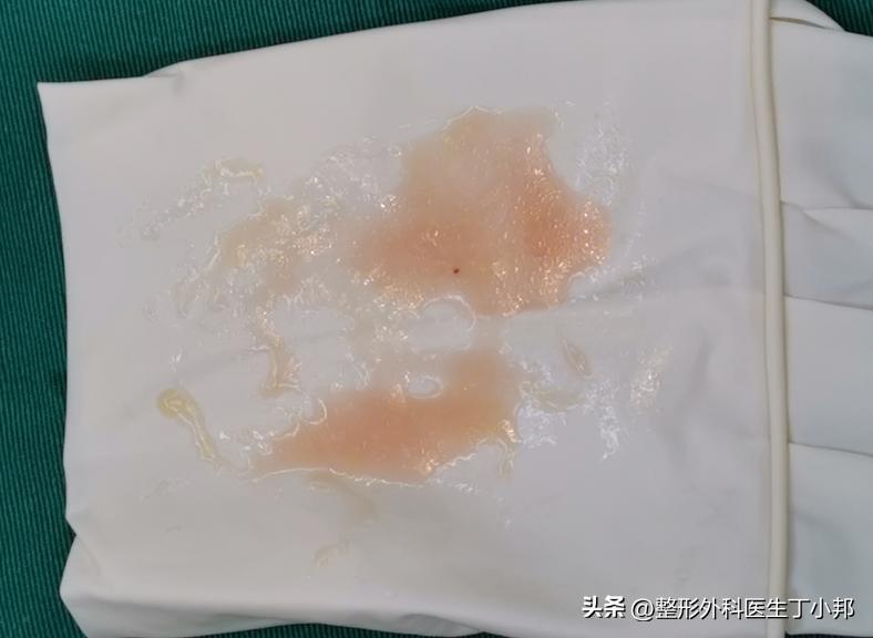 玻尿酸注射鼓包是医疗事故吗,注射玻尿酸有鼓包是怎么回事视频