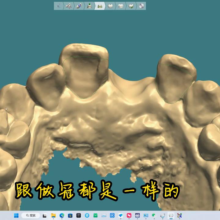 口腔临时牙制作视频,种植临时牙制作