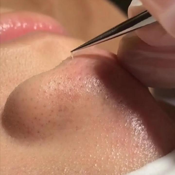 鼻子上有黑点怎么抠掉,鼻子边缘的小白点怎么去除